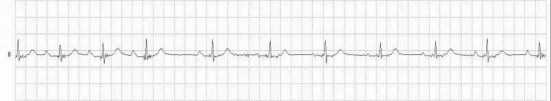 wandering atrial pacemaker