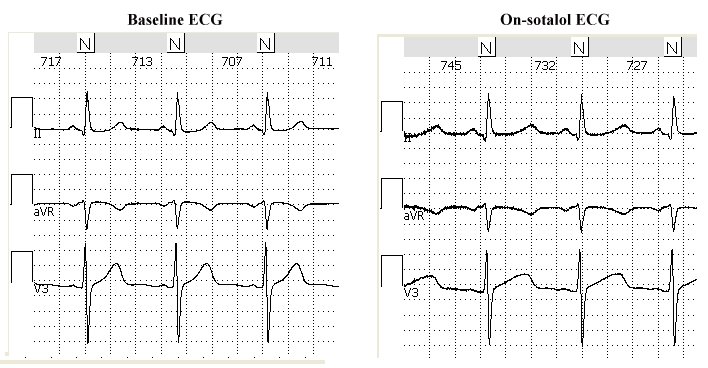 on sotalol